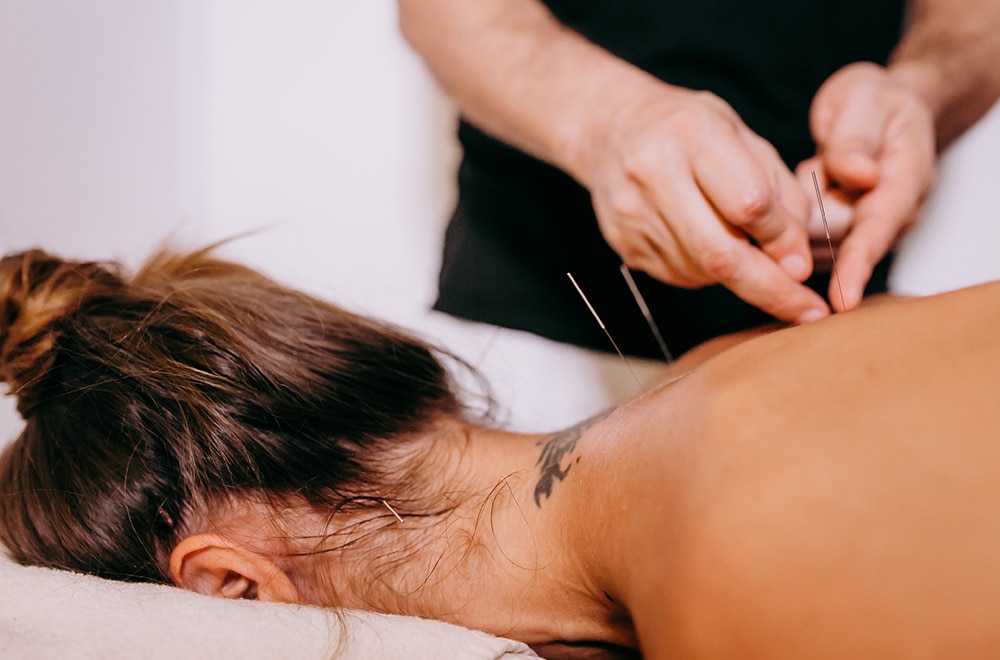 Woman receiving acupuncture